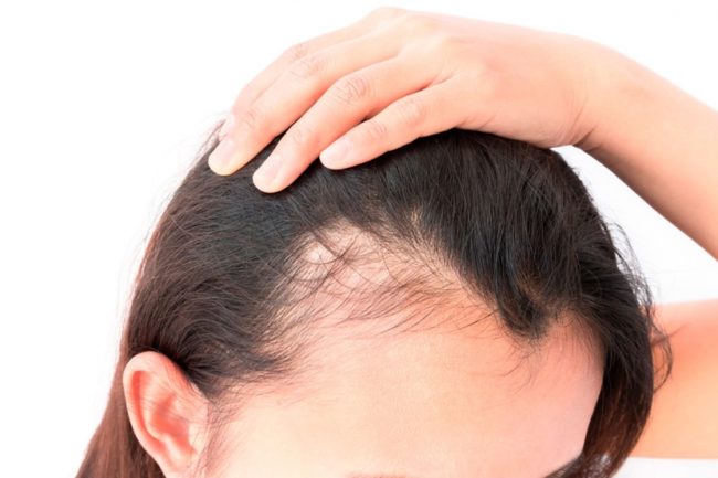 Alopecia en mujeres