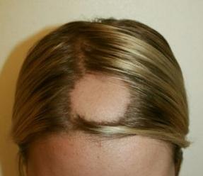 Alopecia areata