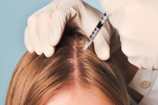 Mesoterapia - Tratamiento caida del pelo