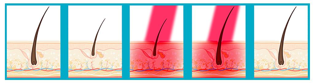 Láser de Baja potencia - Tratamientos para la caida de pelo